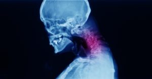 What is the Average Average Settlement for Cervical Radiculopathy after a Car Accident?
