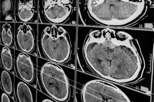 Duluth Traumatic Brain Injury Lawyer