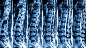 Spinal Cord Injury Lawyer in Riverdale, GA | Kaine Law Riverdale Spinal Cord Injury Attorney