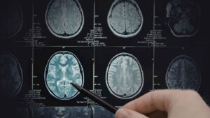 Traumatic Brain Injury Attorney in Fairburn, GA | Kaine Law Fairburn Traumatic Brain Injury Attorney