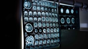 Gainesville Traumatic Brain Injury Attorney